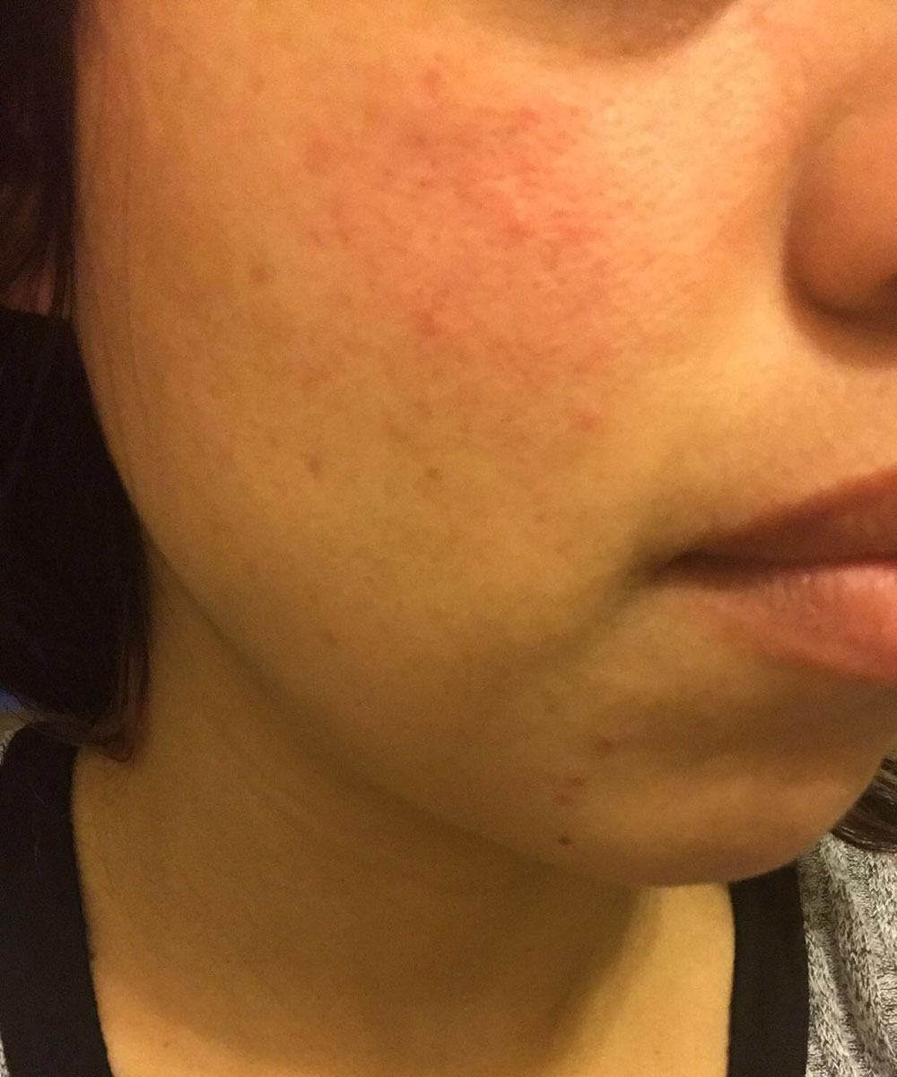 Acne After