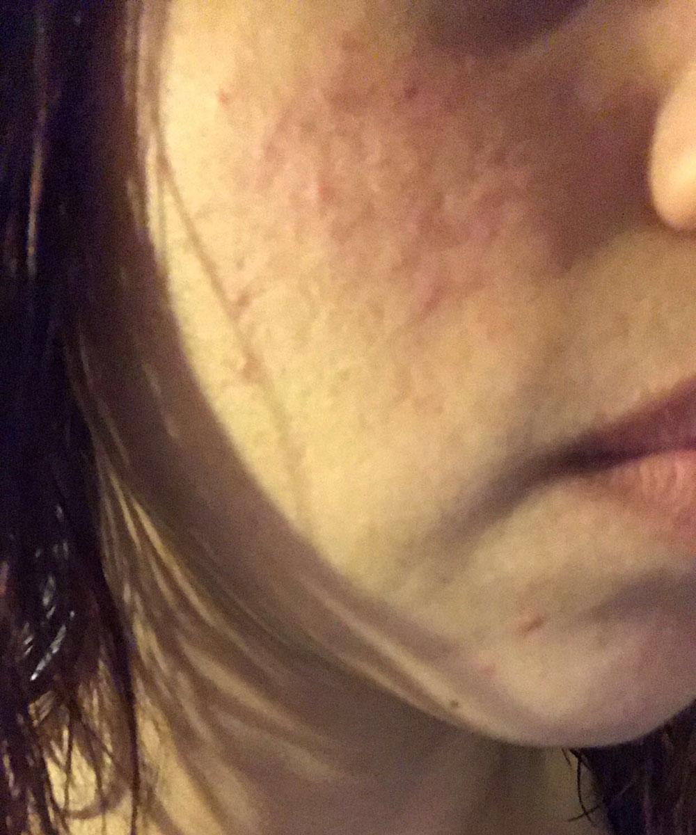 Acne Before